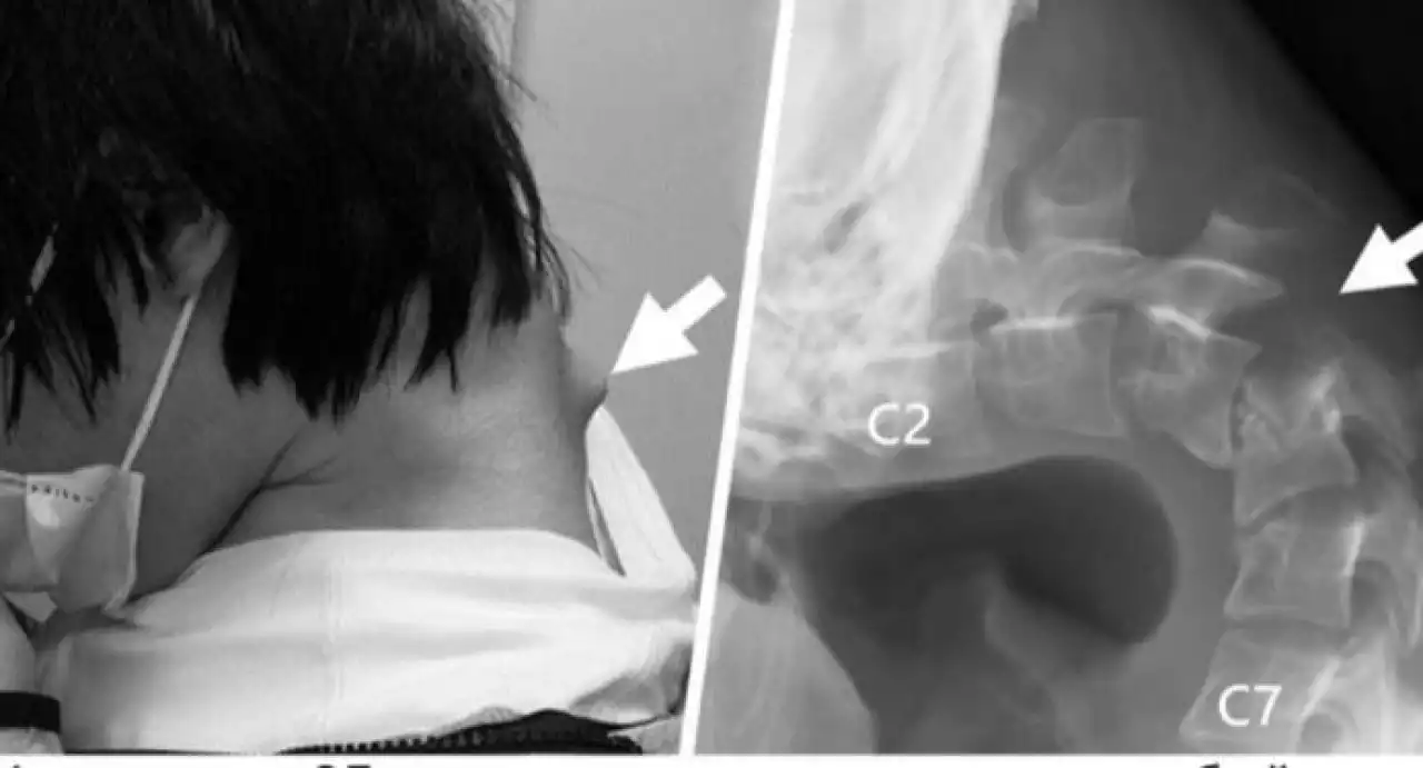 Телефонға ұзақ қараған 25 жастағы жігіт мойнын көтере алмай қалды