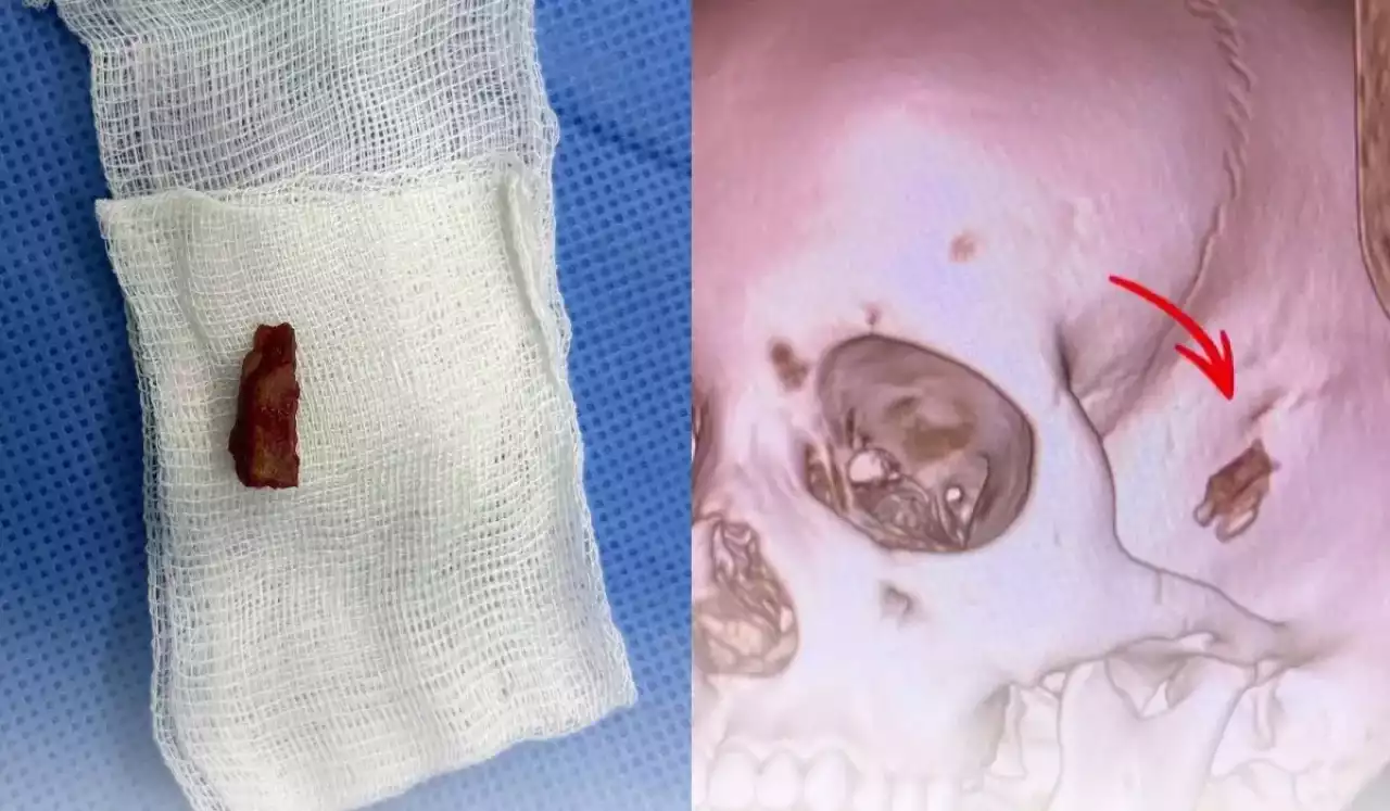 Павлодарда баланың басына ота жасалып, бес жыл бұрын қалған ағаштың сынығы алынды