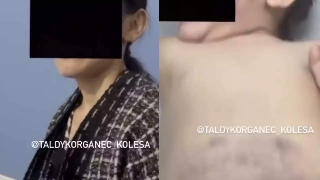 «Ішкі құрылысына зақым келген»: Жетісуда туған қызын ұрды деп күдікке ілінген әкеге қатысты жаңа дерек пайда болды