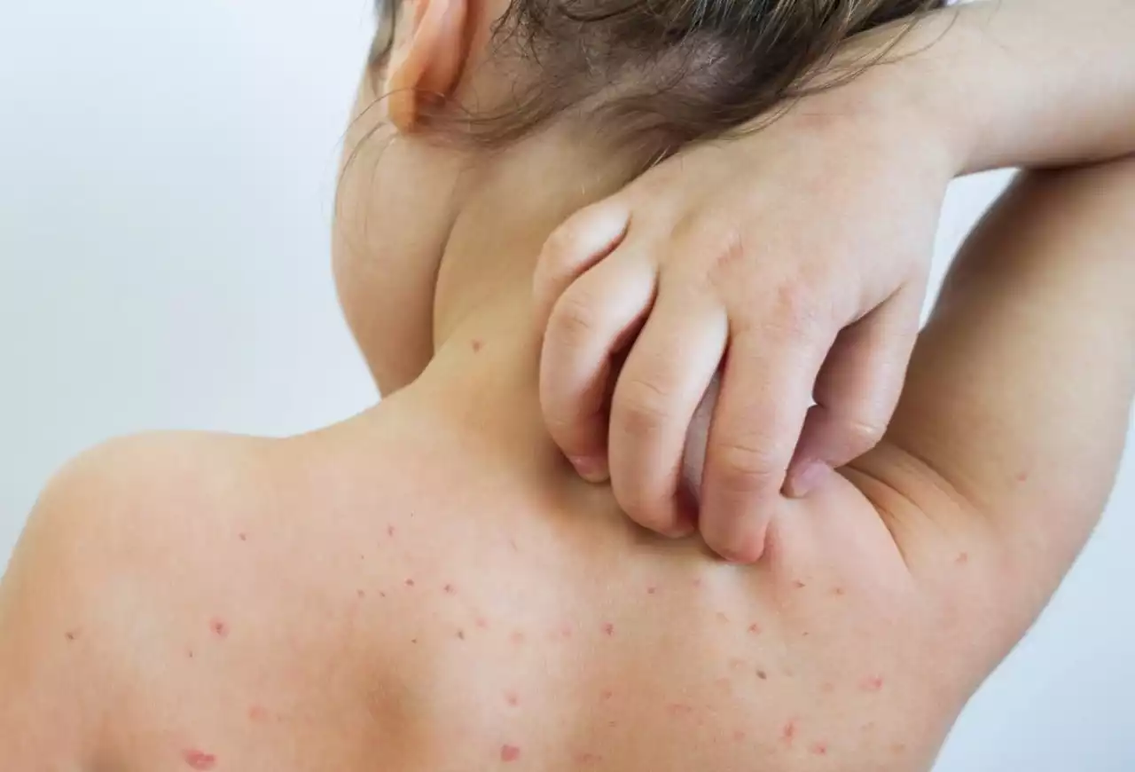 Қазақстанда қызылша ауруы өршіді: министрлік ата-аналарға үндеу жасады