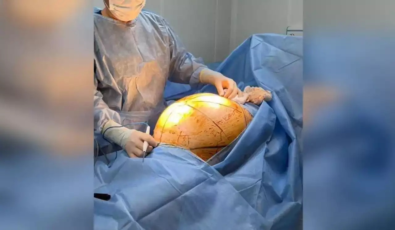 «Аяғы ауыр сияқты көрінген»: Алматыда дәрігерлер 69 жастағы әйелдің ішінен 25 келі болатын қатерлі ісікті алып тастады