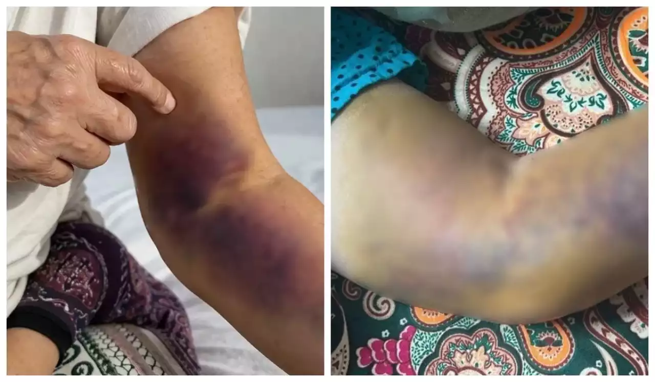 Ақтауда әйелдің қолы тамырына салынған екпеден кейін қозғалмай қалған