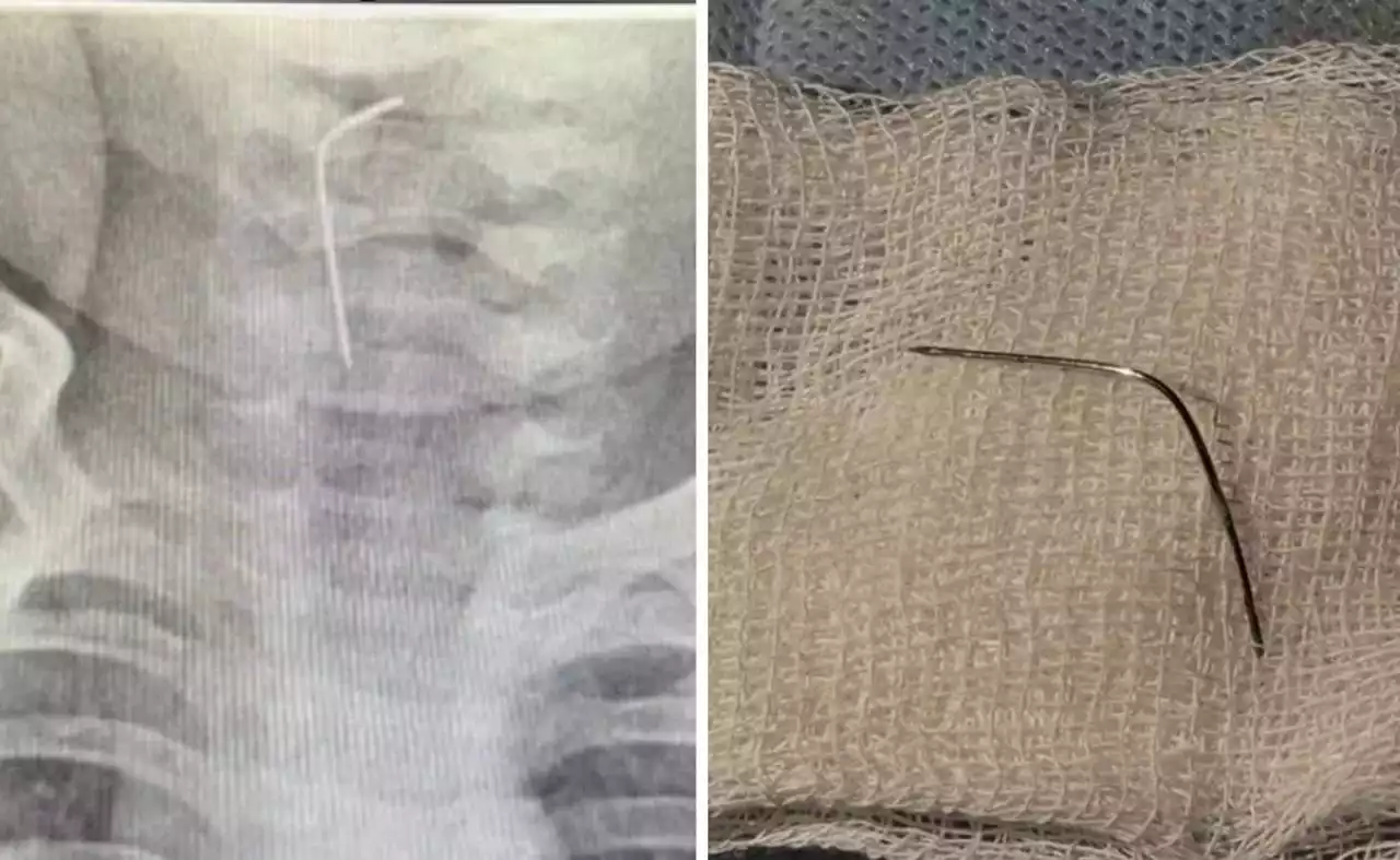 Түркістан облысында дәрігерлер ине жұтып қойған 9 айлық сәби аман алып қалды