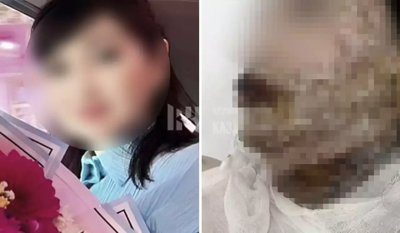 "Басы, беті, мойны, кеудесі күйген": Шымкентте ер адам экс-жұбайының бетіне қышқыл шашып жіберген